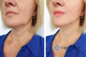 Book your double chin treatment Woburn today! We are here to help!