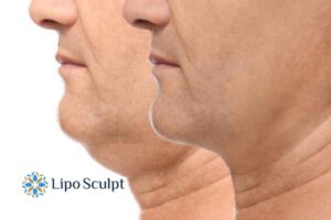 Double chin treatment Woburn from Lipo Sculpt - feel more confident today!