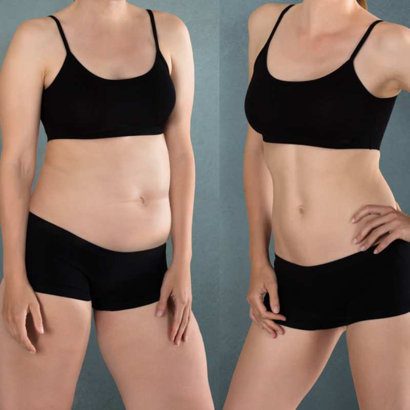 Does Fat Freezing at Home Work? DIY Devices vs Professional Cryolipolysis 2 before and after Cryolipolysis Woburn